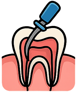 Wurzelkanalbehandlung